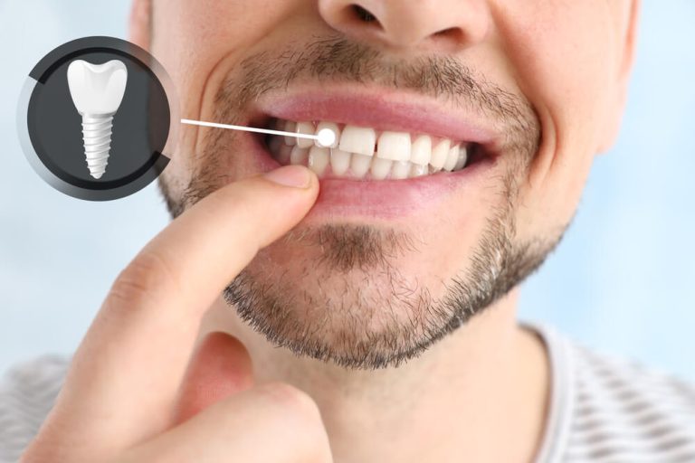 pielęgnowanie implantów zębowych