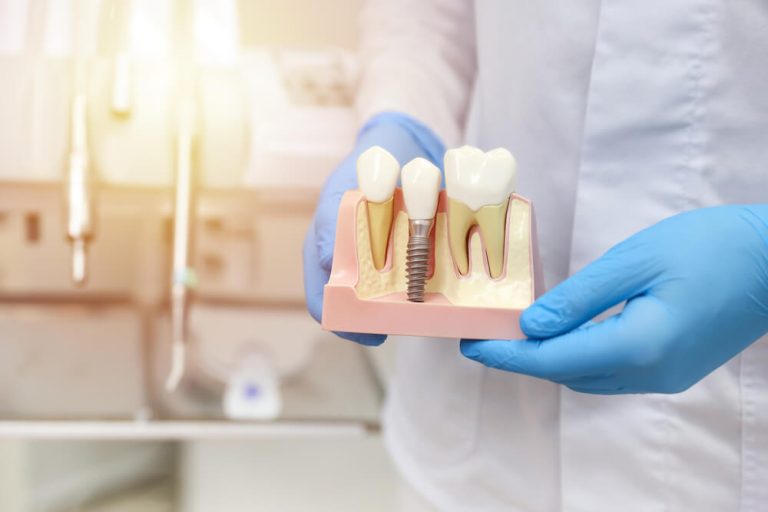wszczepienie implantów zębowych