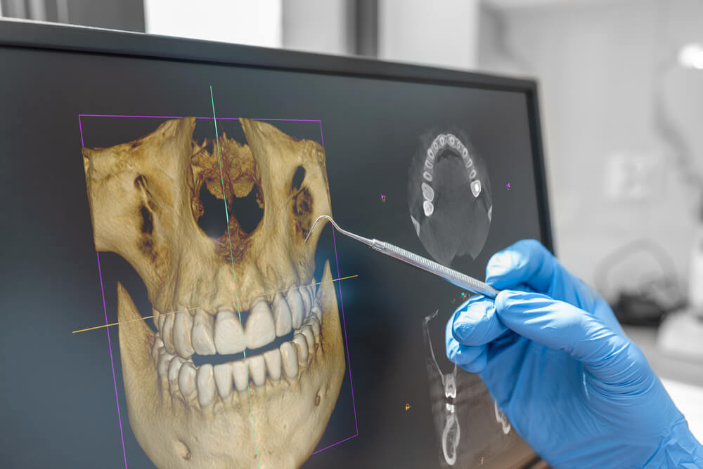 tomografia cbct