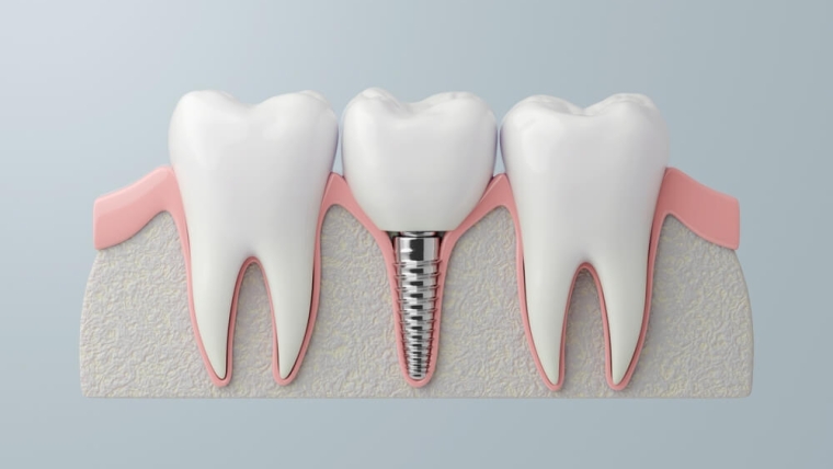 Kiedy implanty stomatologiczne nie są zalecane? Przeciwwskazania do zabiegu