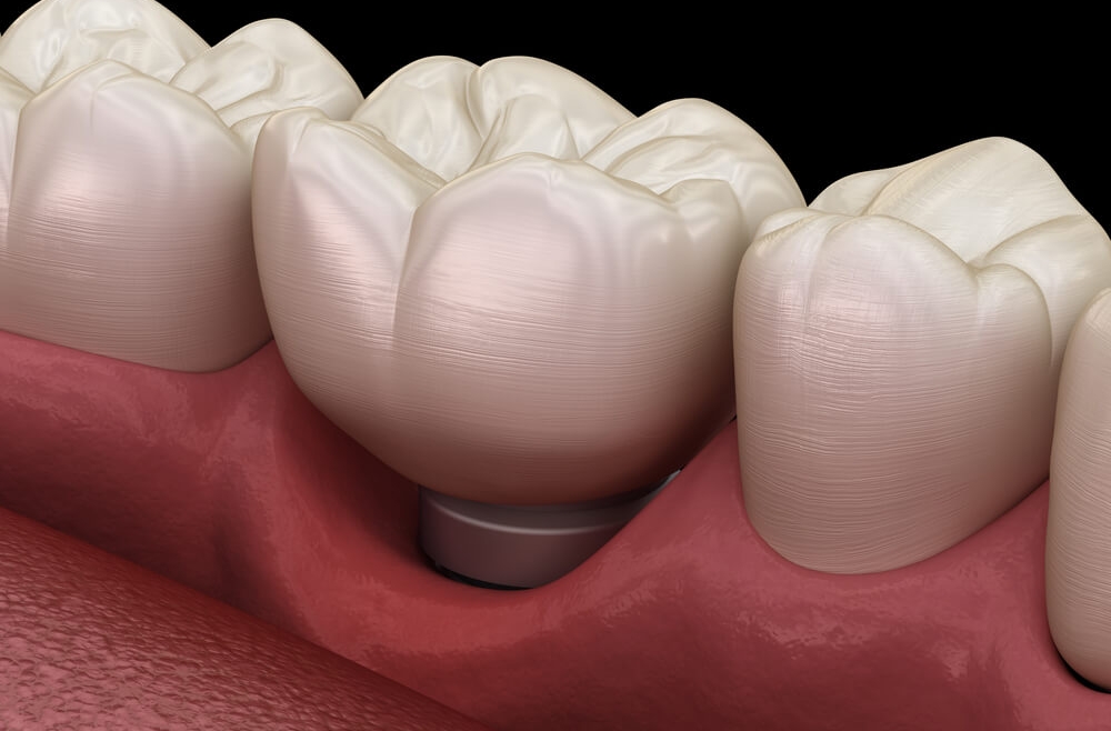 Periimplantitis – poradnik dla pacjentów implantologicznych