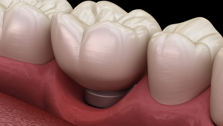 Periimplantitis – poradnik dla pacjentów implantologicznych