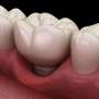 Periimplantitis – poradnik dla pacjentów implantologicznych