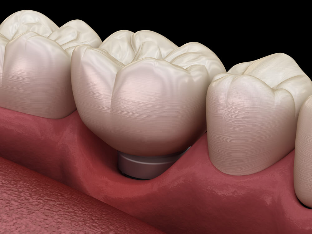 periimplantitis- co to jest