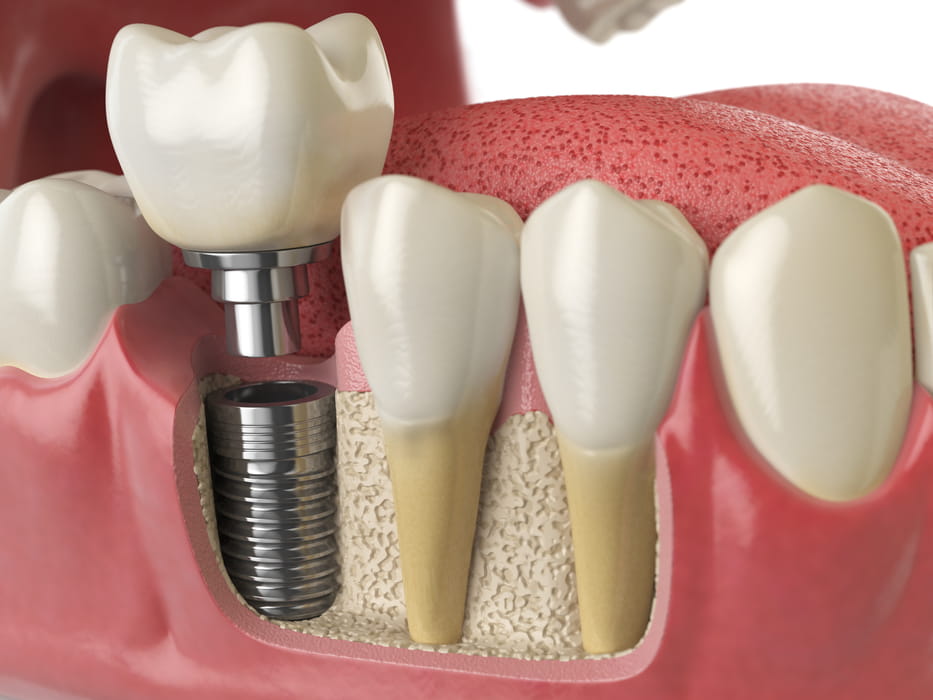 Model implantu zębowego wszczepionego w kość między naturalnymi zębami